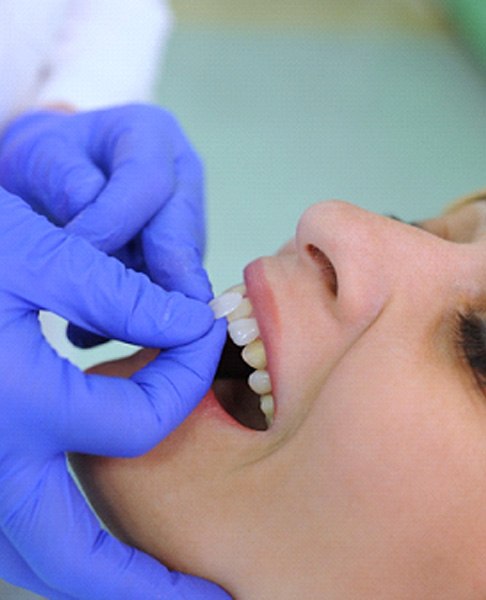 A dentist placing veneers on a woman’s teeth