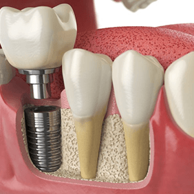 a digital illustration of a dental implant, abutment, and restoration