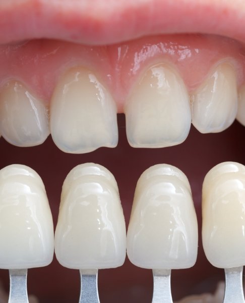 Smile compared to porcelain veneer options during cosmetic dentistry visit
