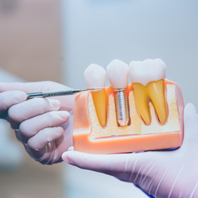 Dentist pointing to model of dental implant