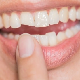 Closeup of smiled with chipped front tooth