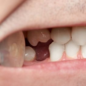 Closeup of smile with knocked out tooth