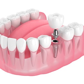 diagram illustrating the parts of dental implants