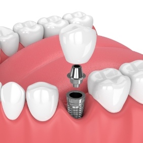 Animated dental implant supported dental crown placement