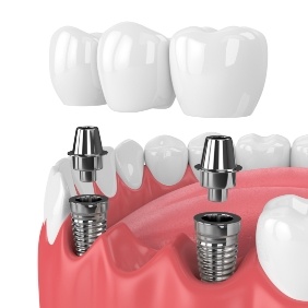 Animated dental implant supported fixed bridge placement