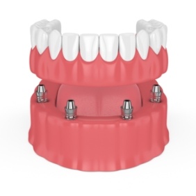 Animated dental implant supported denture placement