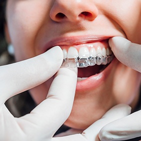 Closeup of white-gloved hands removing a woman’s Invisalign