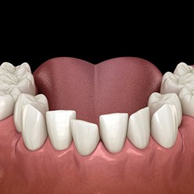 a 3 D illustration of crowded teeth