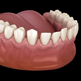 a 3 D illustration of gapped teeth