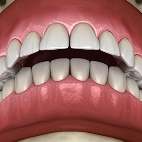 a 3 D illustration of an overbite