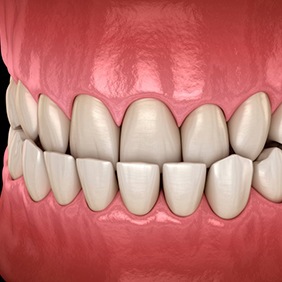 a 3 D illustration of an underbite