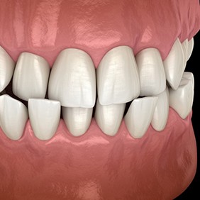 a 3 D illustration of a crossbite