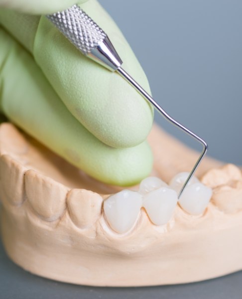 Model smile with dental bridge restoration