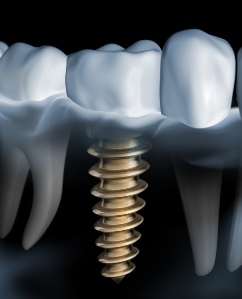 Animated dental implant supported dental crown