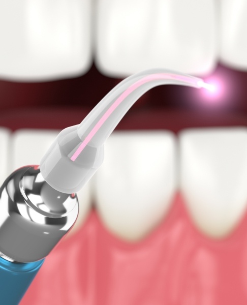 Animated laser periodontal therapy tool