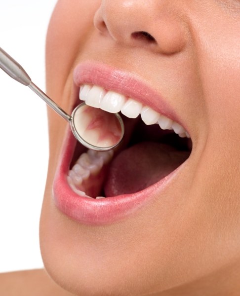 Dentist examining smile after tooth colored fillings