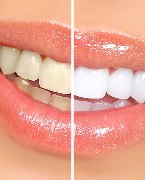 Different types of teeth whitening can vary in price
